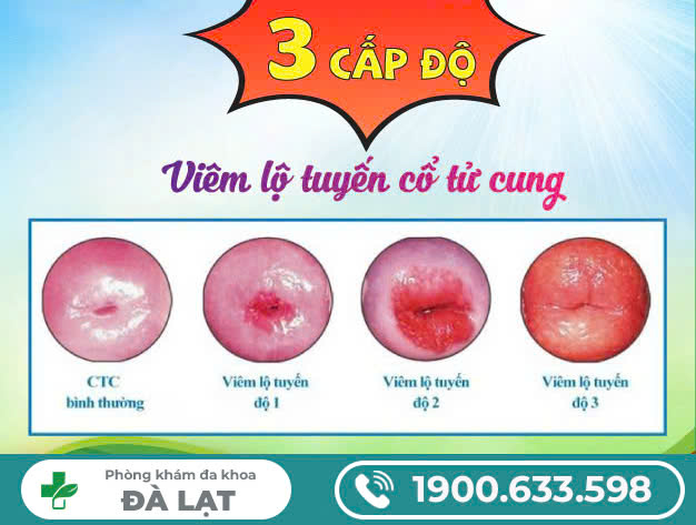 Viêm lộ tuyến có mấy cấp độ, do nguyên nhân nào?